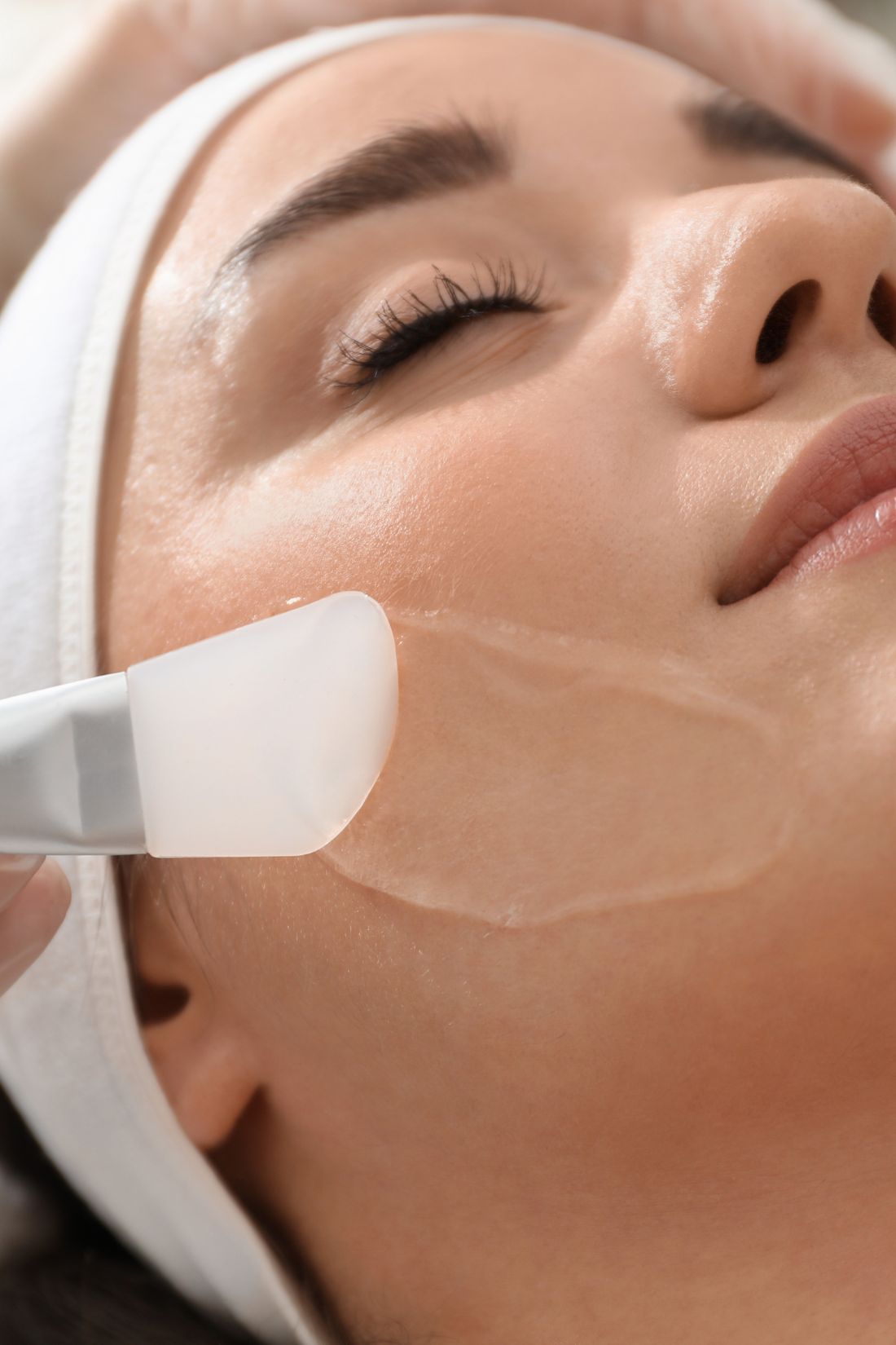 Chemical Peeling ( Acne/Acne Scars )