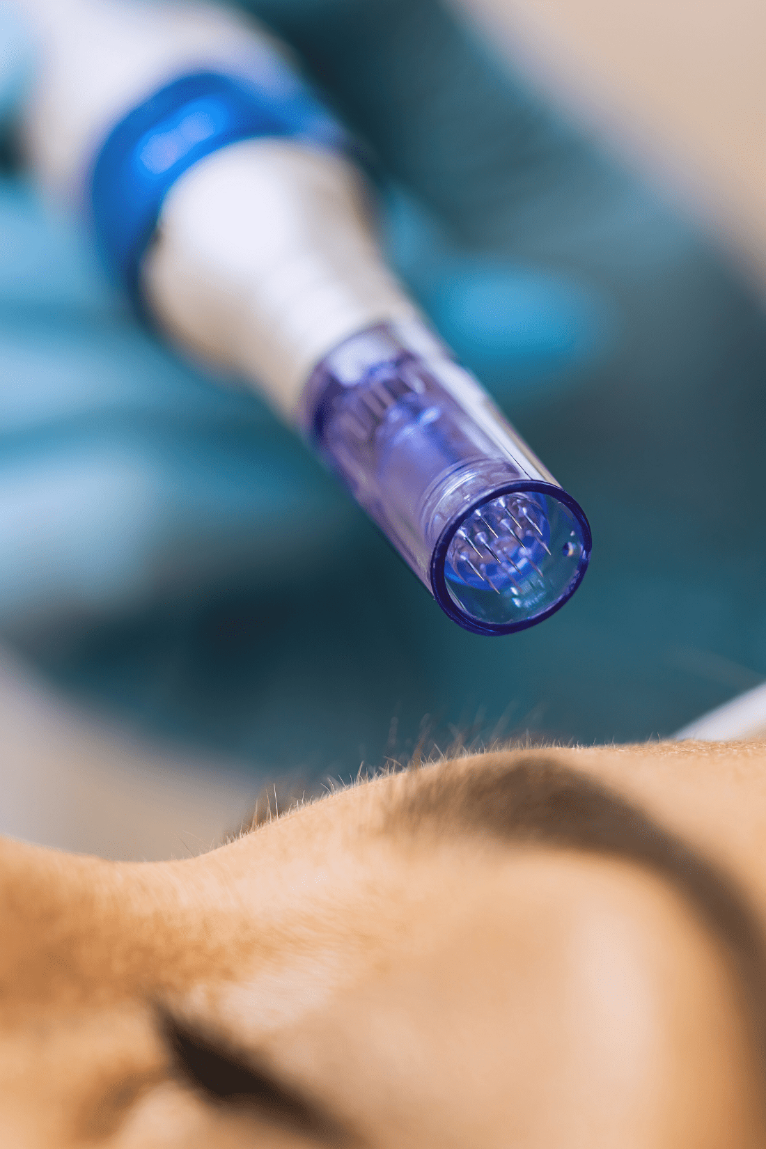 Microneedling Therapy