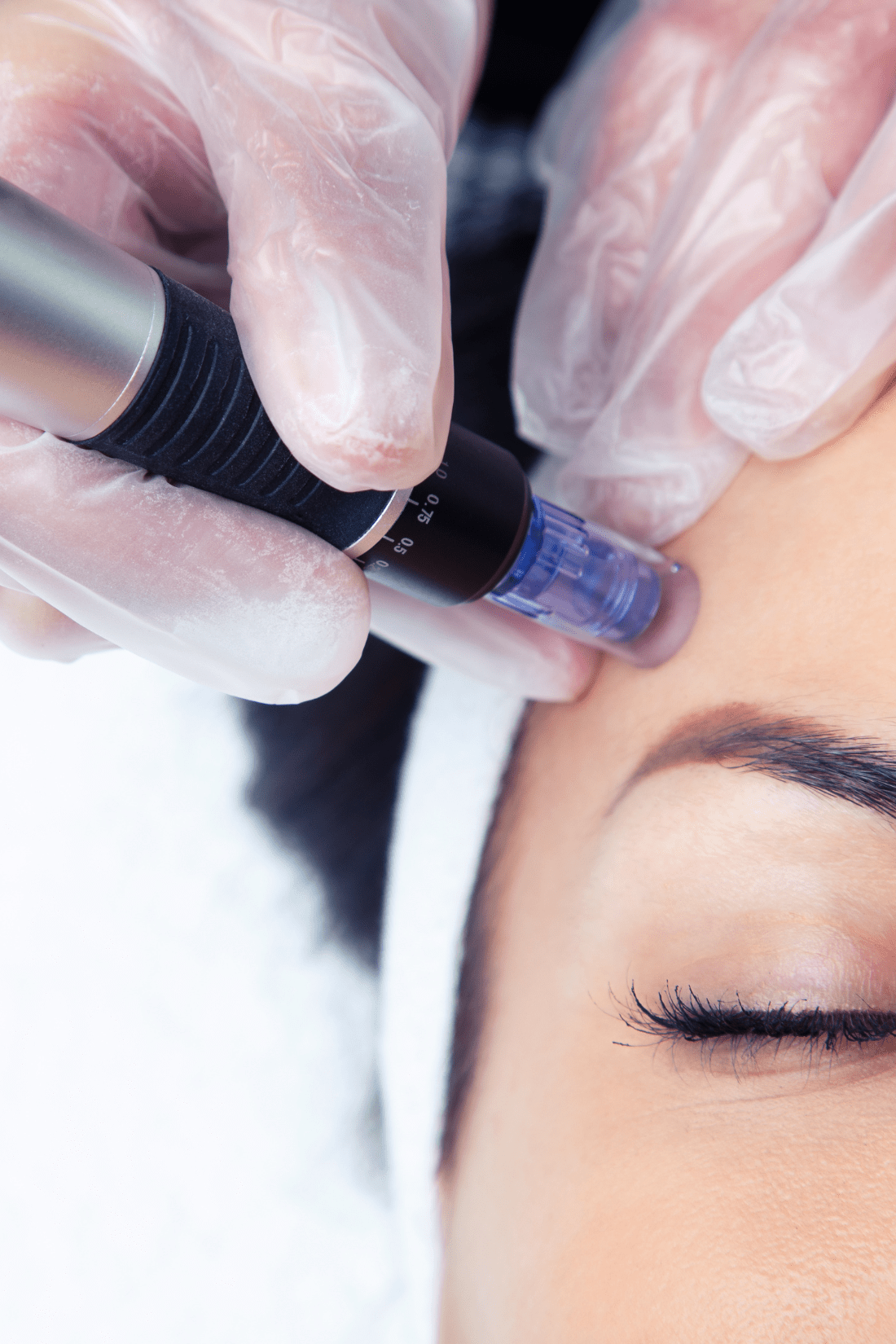 Microneedling Therapy